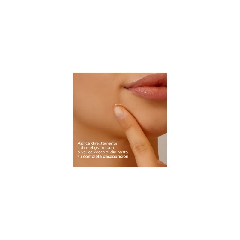 Isdin Acniben On the Spot corrector granos faciales, 15 ml Isdin Acniben On the Spot corrector granos faciales, 15 ml