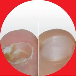 Isdin SI-NAILS MicoXpert MD resultados