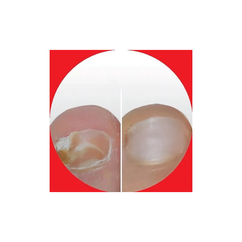 Isdin SI-NAILS MicoXpert MD resultados