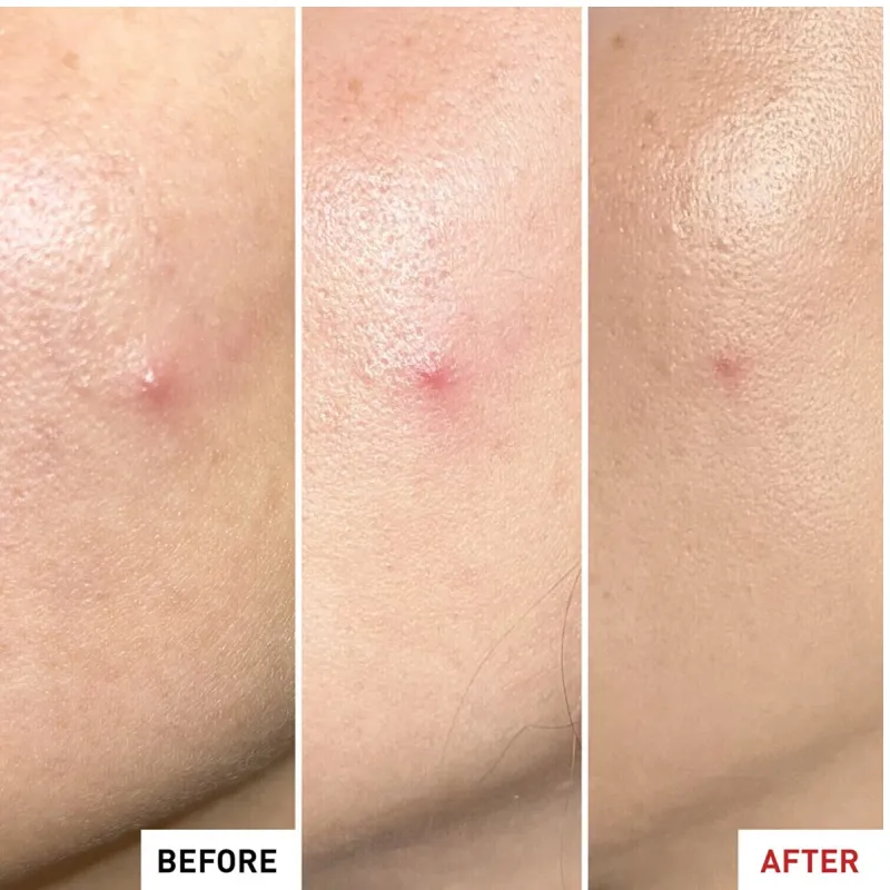 Erborian centella sos patch, 9 ml