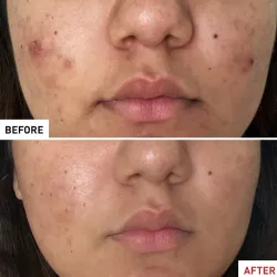 Erborian centella acne care, 30 ml Erborian centella acne care, 30 ml