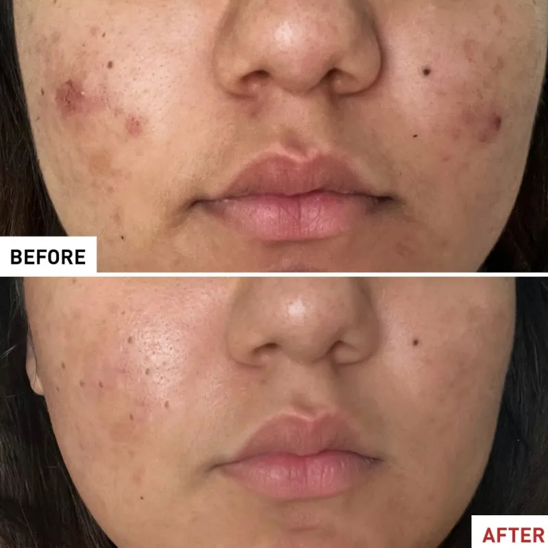 Erborian centella acne care, 30 ml Erborian centella acne care, 30 ml