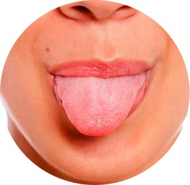 Candidiasis