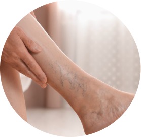 Varices/Piernas Cansadas